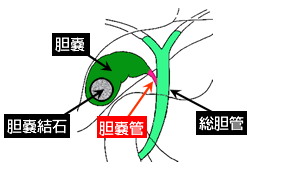 腹腔鏡下胆嚢摘出術における蛍光胆管造影法の開発 Jcho東京山手メディカルセンター 地域医療機能推進機構