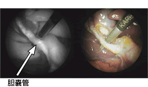 腹腔鏡下胆嚢摘出術における蛍光胆管造影法の開発 Jcho東京山手メディカルセンター 地域医療機能推進機構