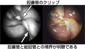 腹腔鏡下胆嚢摘出術における蛍光胆管造影法の開発 Jcho東京山手メディカルセンター 地域医療機能推進機構