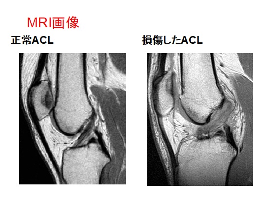 手術（膝靱帯損傷・半月板損傷） | JCHO東京山手メディカルセンター